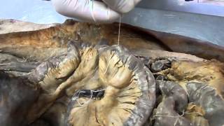 киссетный серозно мышечный кишечный шов