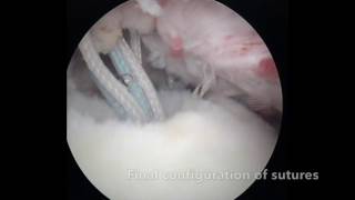 Subscapularis repair