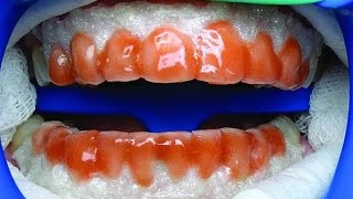 Химическое отбеливание зубов