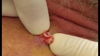 FLYING PIMPLE  on the neck. ЧТО БУДЕТ, ЕСЛИ ДАВИТЬ ПРЫЩИ?