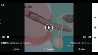 sperm retrieval procedure for conception
