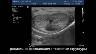 Искривление полового члена.