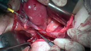 Wertheim,s radical hysterectomy  & Pelvic Lymphadenectomy  سرطان عنق الرحم