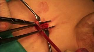İnmemiş Testis Ameliyatı
