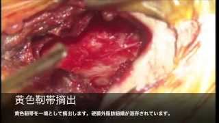 腰部脊柱管狭窄症の低侵襲除圧椎弓形成術