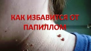 Как избавится от папиллом. Рекомендации др.Ульвии Голденбрук.Центр интегративной медицины Шерома