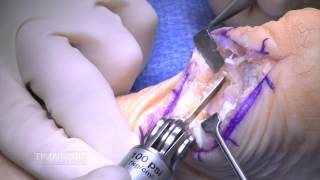 Achilles Tendon Debridement and Removal of Bone Spur with Arthrex Speed Bridge