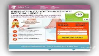 вальгусная деформация 1 пальцев стоп опе

  - рекомендую лечение hallux valgus косточки