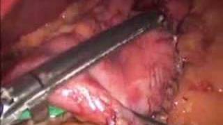 Laparoscopic Vertical Sleeve Gastrectomy