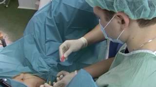 Криоаблация предстательной железы