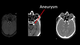 PCOM Aneurysm Clipping Video - Brigham and Women's Hospital