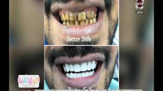 في إيد أمينة | تعرف على تقنية "الفـيـنــير"‏ في علاج مشاكل الأسنان