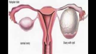 what are signs of ovarian cysts - ovarian cysts and pain - ovarian cysts cure