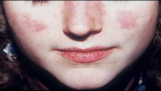 Discoid Lupus Erythematosus Treatments