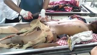 Postmortem video||Dissection human body ||Alcohol patient