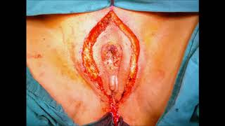 Radical vulvectomy  and BIFLND  for Clıtoral Cancer