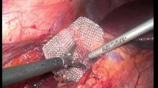 Laparoscopic nephropexy - Лапароскопическая нефропексия