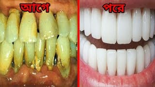 হলদে দাঁত সাদা ও দুর্বল দাঁত মজবুত করার ম্যাজিক পেস্ট।দাঁত সাদা ও মজবুত করার উপায়।