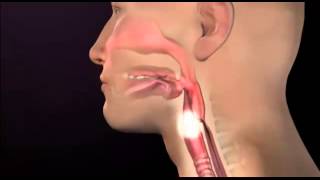 Tracheotomy video - Video of normal airways & swallowing mechanism