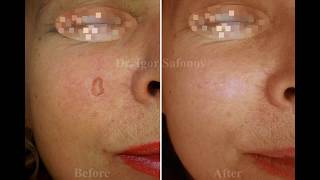 Microdermabrasion of atrophic scar. Микродермабразия атрофического рубца