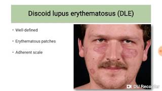 Discoid Lupus Erythematosus (DLE)