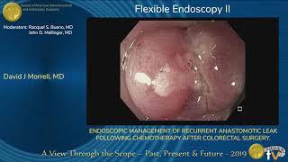 OVER-THE-SCOPE CLIP MANAGEMENT OF NON-ACUTE, FULL-THICKNESS GASTROINTESTINAL DEFECTS