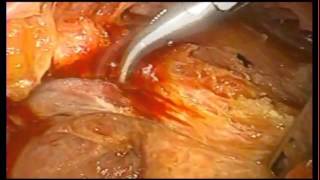 Colorectal cancer — laparoscopic surgery