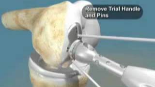 Arthrosurface Knee Part 2