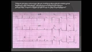 ეკგ/ მარცხენა პარკუჭის ჰიპერტროფია (გულის მარცხენა პარკუჭის გადიდება) marcxena parkuchis hipertrofia