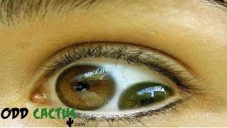 前五名在眼睛上發生的恐怖症狀 Top 5 Scariest Things That Could Happen In Your Eyes