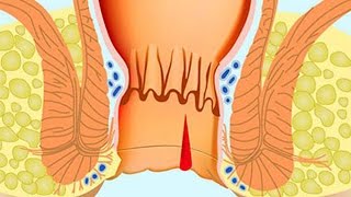Хирургическое лечение анальной трещины - Как вылечить анальную трещину