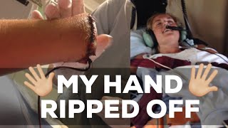 The Day I Almost Died | My Hand Ripped Off