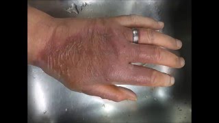 Brandwond / Burnt