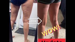 Cellulite Reduction Cupping