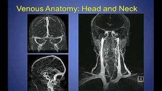 Donald Ponec, MD [Techniques of CCSVI Treatment | CCSVI Symposium 2011 - 32 of 46]