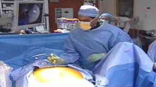 InterStim Therapy for Bladder Control Problems
