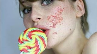Как лечить угревую болезнь, прыщи, акне на лице и теле