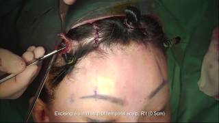 【LIFT】Endoscopic Brow Lift Using Endotine Fixation TechniqueAdvanced 4 Incision Method
