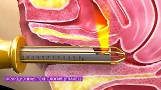 Как вагинальное омоложение Fraxel Co2  помогает улучшить оргазм| Вульво-вагинальное омоложение