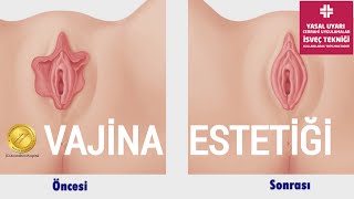Vajina Estetiği Nasıl Yapılır