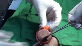 ShangRing - Non-Flip Circumcision Surgery with Topical Anesthesia (Video 2)