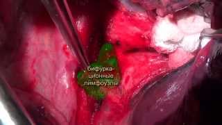 Открытая верхняя лобэктомия справа с медиастинальной лимфодиссекцией.