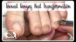 ?Pedicure Tutorial: Thinning Thick Toenail Fungus Nail Transformation ?✔️