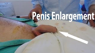 Penis Enlargment with Fat Grafts and PRP in Belarus // Увеличение полового члена липофилингом с PRP