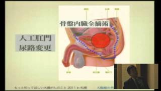 「大腸がんの外科的治療と補助療法」久須美 貴哉
