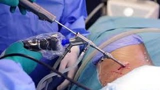 Как Избавиться от Грыжи Межпозвонкового Диска за Один День? Говорит ЭКСПЕРТ
