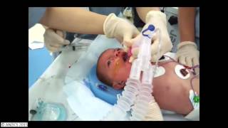 Paul Baker - The Paediatric Difficult Airway