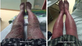 Dermatologist: SEVERE ERYTHRODERMIC & PLAQUE PSORIASIS HEALING IN 23 DAYS with EnerFlex Nutrition