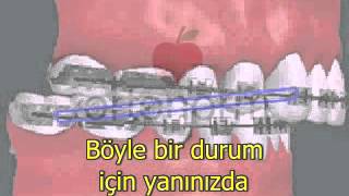 Diş Teli Lastikleri - Elastik Kullanımı - 2