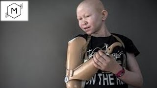 Albinos mutilated in Malawi
